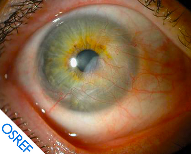 Amniotic Membrane Transplantation for Limbal Stem Cell Deficiency - Osref